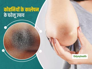 Home Remedies For Dark Elbows: कोहनियों के कालेपन को जल्‍द दूर करेंगे ये 4 सस्‍ते और असरदार घरेलू उपाय 