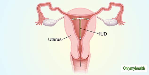pregnancy