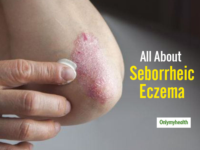 All About Seborrheic Eczema, A Skin Condition Explained By Dermatologist