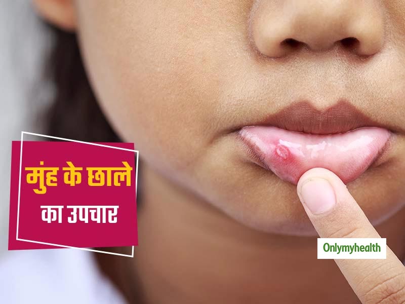 summer-tips-3-ayurvedic-remedies-for-mouth-ulcer-and-stomach-heat-in