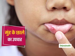 मुंह के छालों का कारण है शरीर में गर्मी और पित्त बढ़ना, जानें आयुर्वेद के अनुसार 3 आसान उपचार