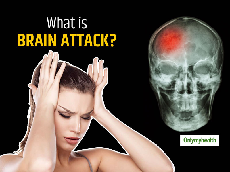 Brain Attack: Causes, Signs And Symptoms | OnlyMyHealth