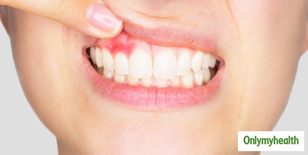 insidebruxism