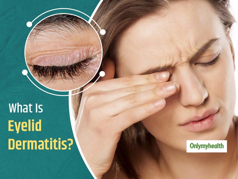 Eyelid Dermatitis or Dry Eyelids Is A Common Problem, Tackle It With These Tips