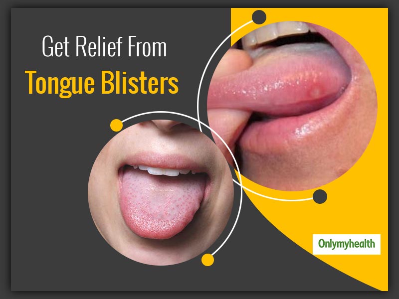 Have Blisters On Tongue? Treat Them Before They Cause Infection, Try These Remedial Options
