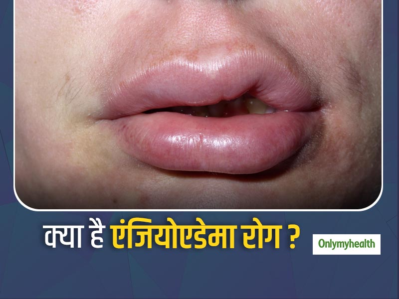 Angioedema Diseases: क्या है एंजियोएडेमा रोग? जानें क्या है इसके प्रमुख कारण और लक्षण 