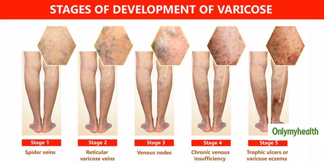 Socks leave marks on legs: Causes and treatment