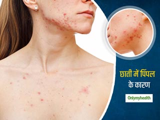 Chest Acne: क्‍या छाती में पिंपल्‍स से आप भी हैं परेशान? तो जानिए चेस्‍ट पिंपल के कारण लक्षण और बचाव 