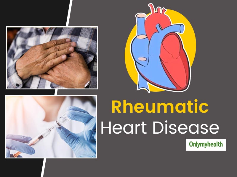 Rheumatic Heart Disease: Causes, Symptoms, Diagnosis, And Treatment