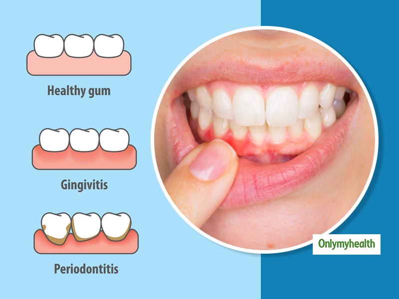 Know-How Menstrual Gingivitis Can Affect Your Dental Health? 
