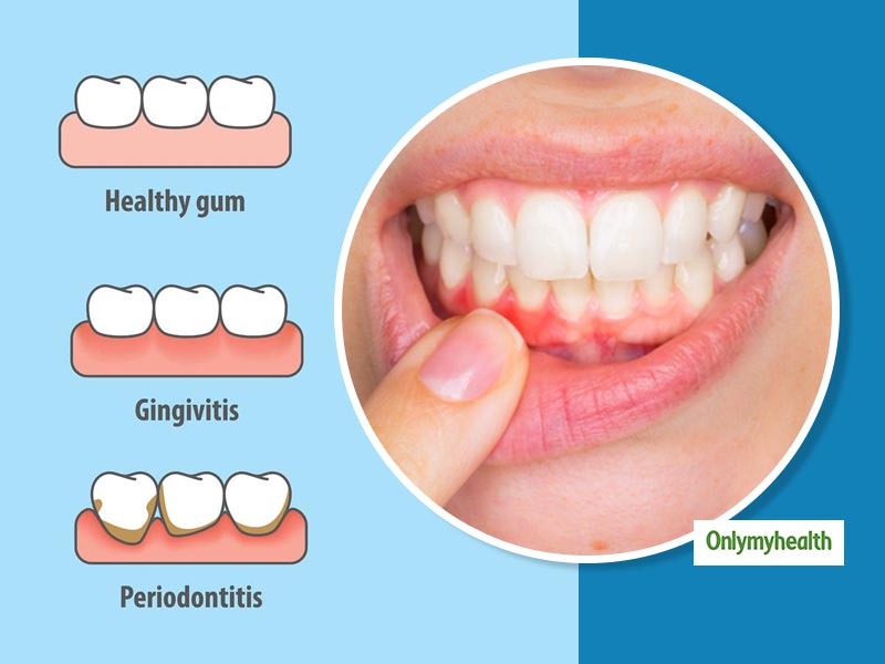 Know-How Menstrual Gingivitis Can Affect Your Dental Health?