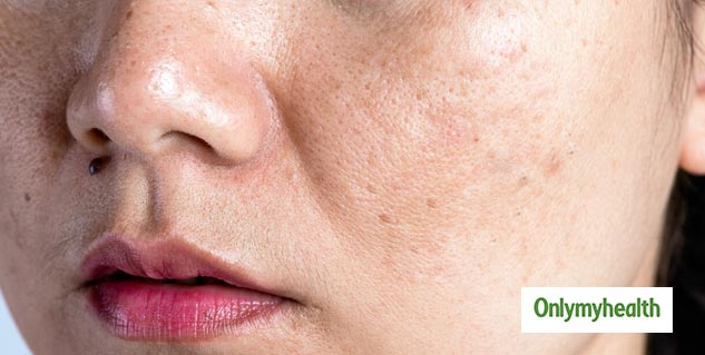 dark spots home remedies