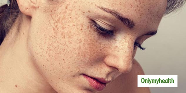 hyperpigmentation home remedies