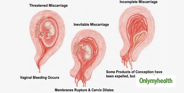 Threatened Miscarriage Know Causes Symptoms Prevention and More