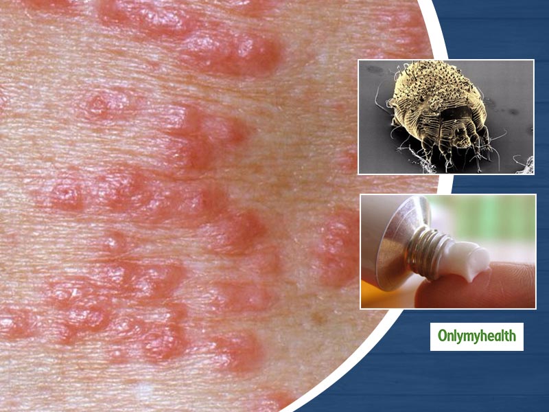 What Is Scabies? Learn About Its Causes, Symptoms And Treatment