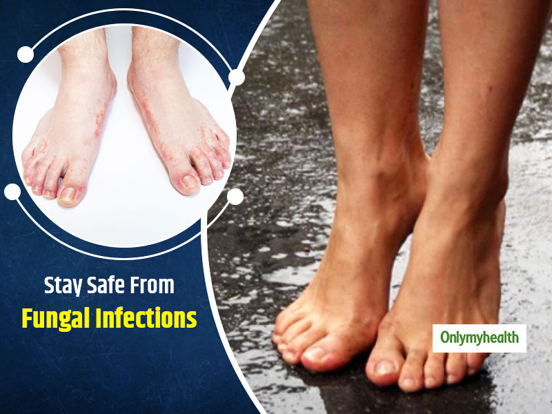 Different Monsoon Fungal Infections And Their Remedial Options