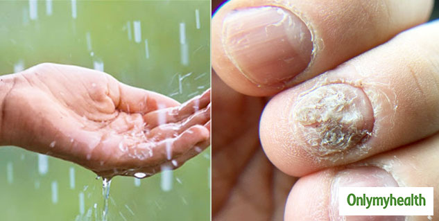 Different Monsoon Fungal Infections And Their Remedial Options Onlymyhealth 1787