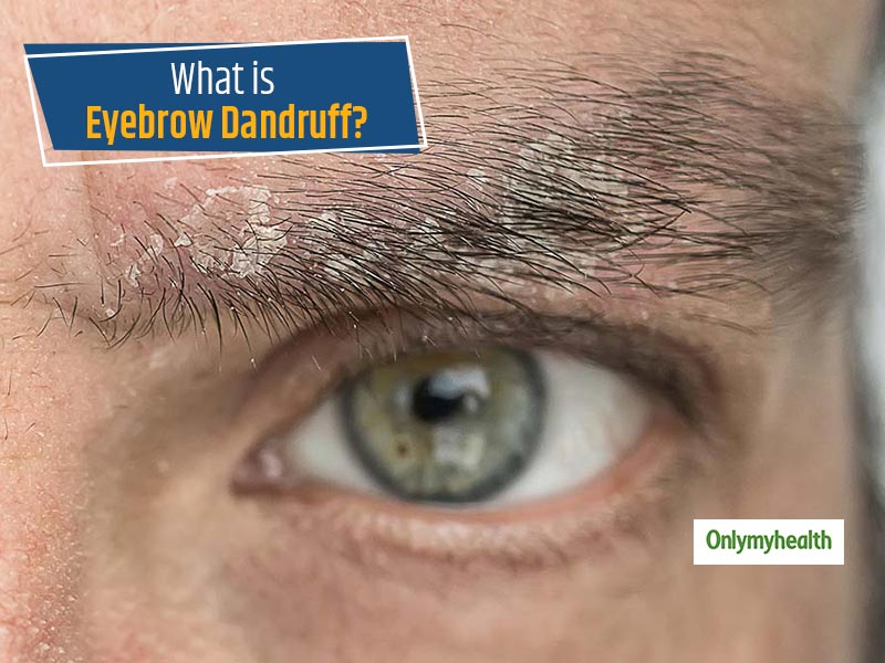 Why Do I Have Eyebrow Dandruff? Seborrheic Dermatitis Explained Goodrx 