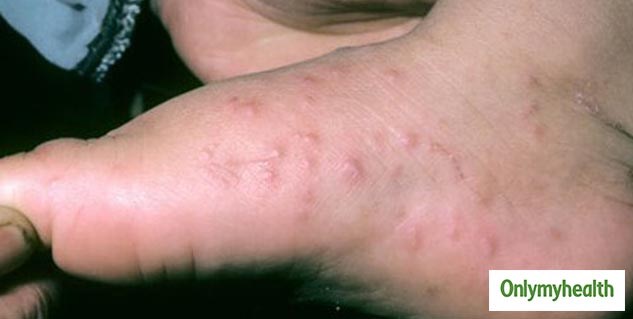 fungal infection