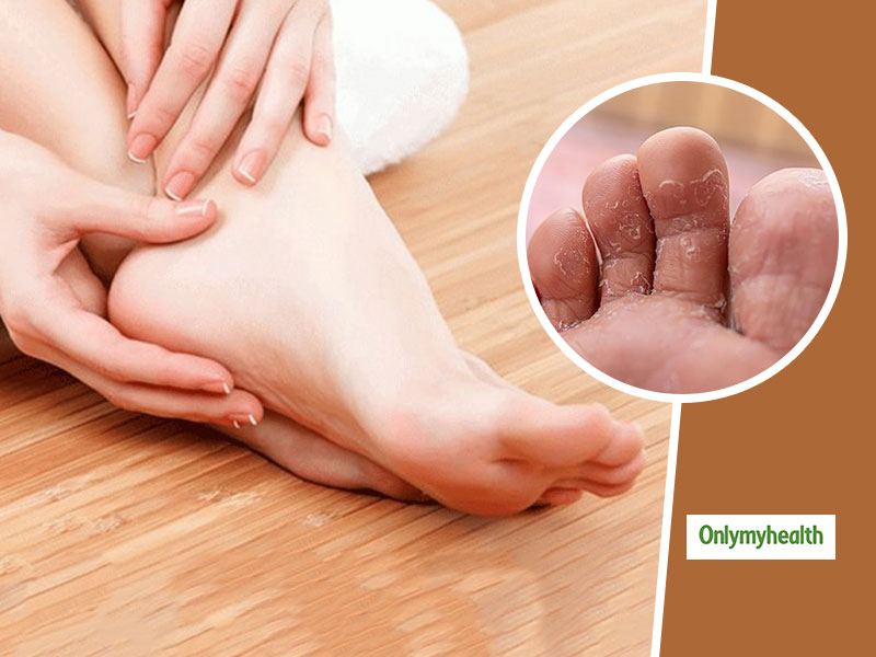 Fungal Infections: बारिश के कारण पैरों में हो रहा है फंगल इंफेक्शन? तो इन 5 आसान घरेलू उपाय से करें इसका इलाज