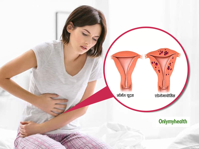 adenomyosis-symptoms-causes-and-treatments-in-hindi