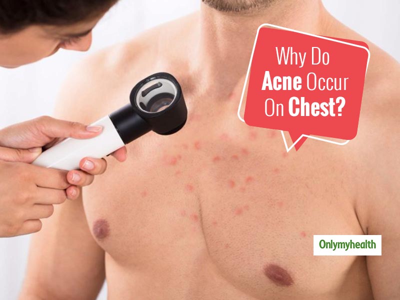 Here's What's Really Causing The Acne On Your Chest