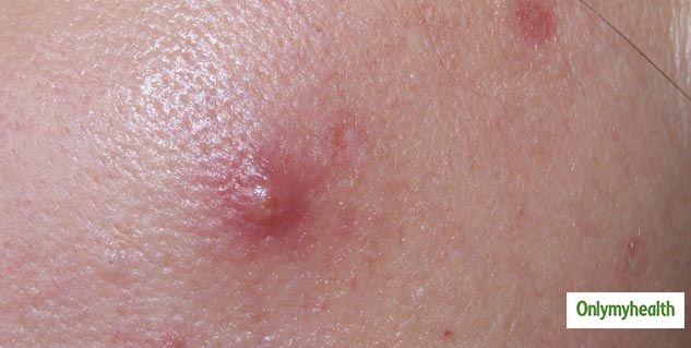 Chest Acne: Dermatologist Explains What Causes Chest Acne and How You