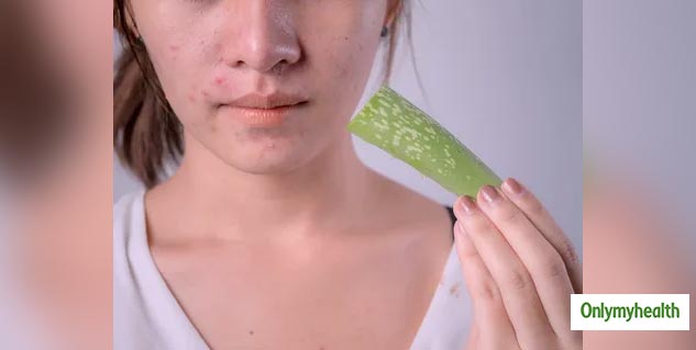 Acne Prevention Tips