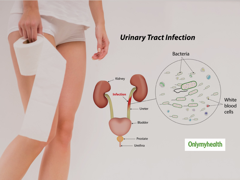 What Is Urinary Tract Infection (UTI)? Here Are Its Causes, Symptoms, Treatment And Preventive Measures
