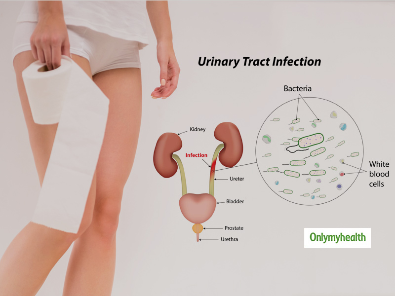 What Is Urinary Tract Infection (UTI)? Here Are Its Causes, Symptoms,  Treatment And Preventive Measures