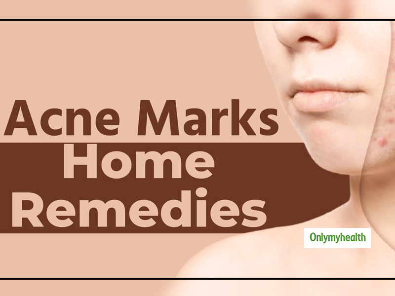 Here Are 3 Effective Home Remedies To Treat Acne Scars