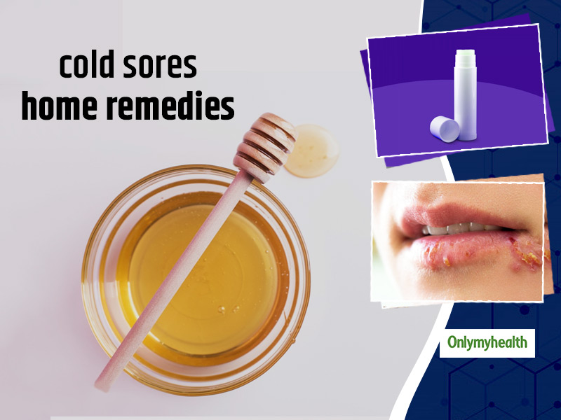 Natural remedies for cold sores