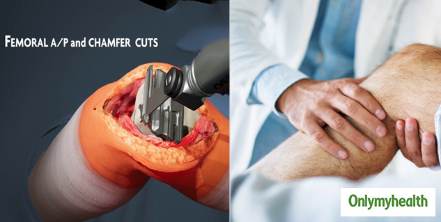 Virtual Total Knee Replacement Know The Procedure, Effects, Pros And