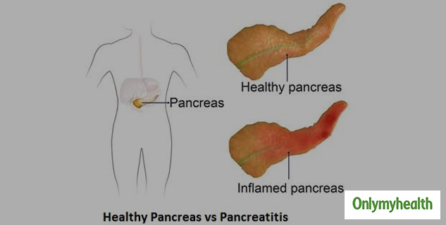 insidepancreatitis