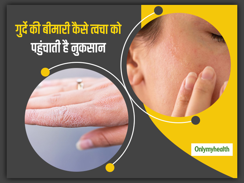 किडनी की बीमारी के कारण भी हो सकती हैं त्वचा की कई समस्याएं, एक्सपर्ट से जानें ऐसा क्यों होता है और इसका इलाज