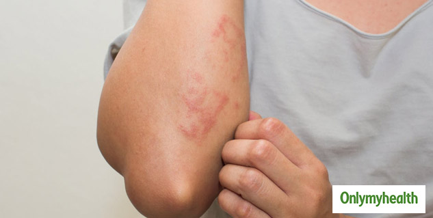 SKIN PROBLEM