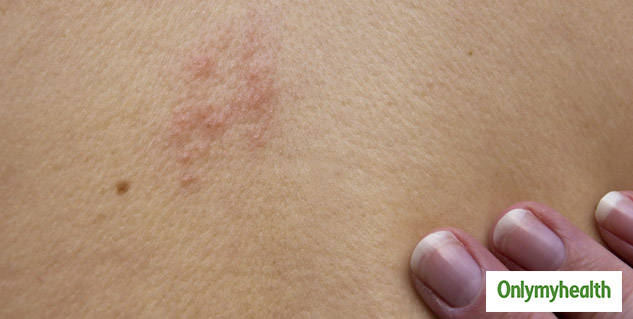 SKIN PROBLEM