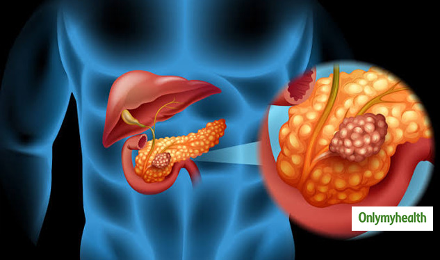 Pancreatic Cancer: Stages, Symptoms, Causes And Treatment | Onlymyhealth