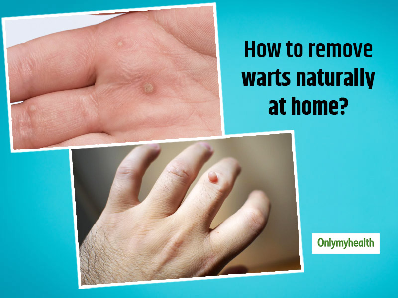 warts on fingers removal