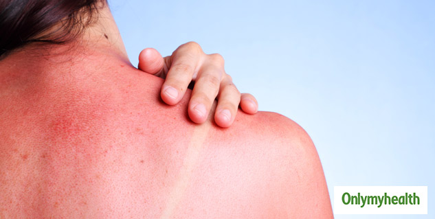 insidesunburneffects