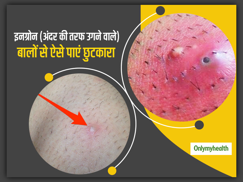 How To Get Rid Of Ingrown Hair With Natural Remedies  Vedix