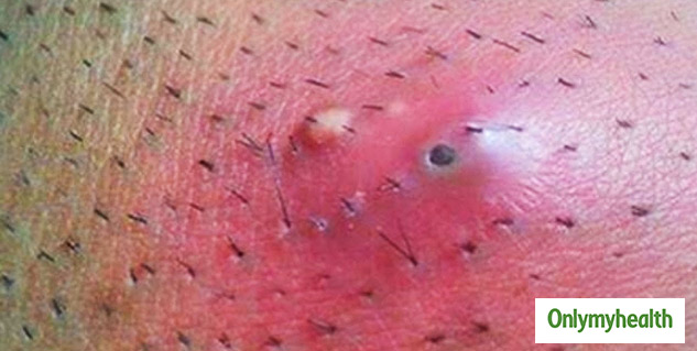 ingrown hair removal tips