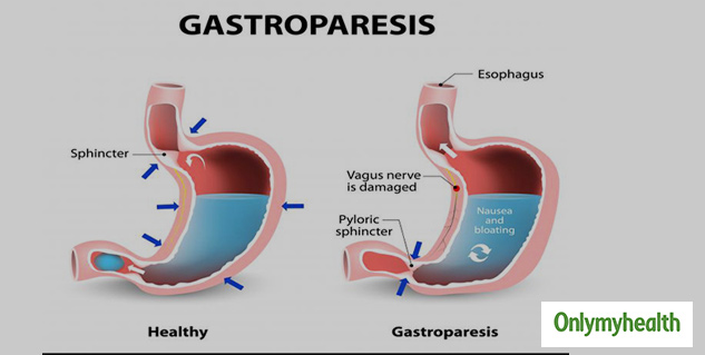 insidegastroparesis