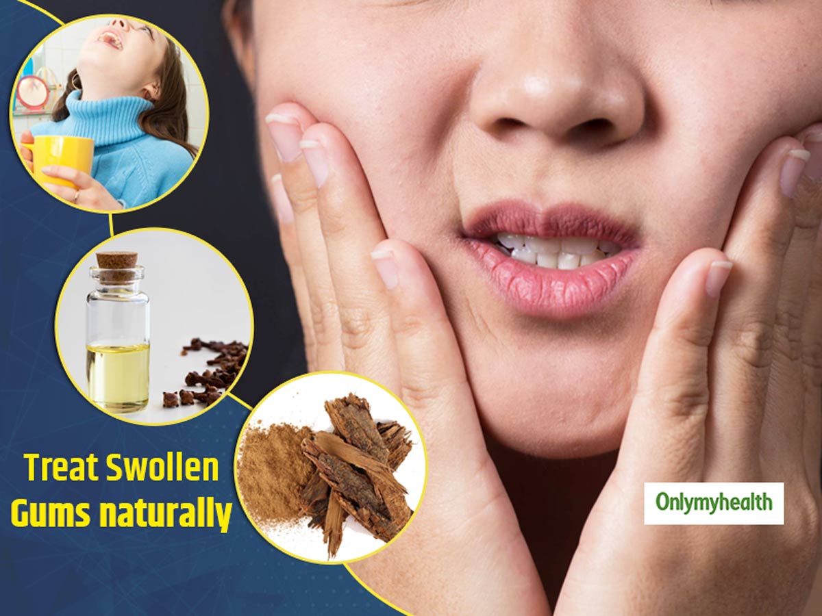Do You Have Swollen Gums? Here Are Some Natural Ways To Get Aid |  Onlymyhealth