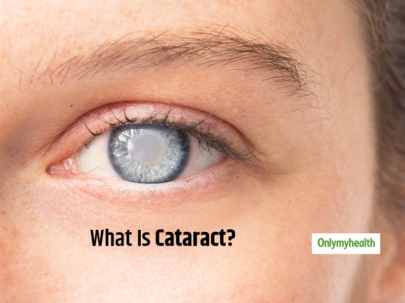 All About Cataract Causes, Symptoms, Treatment and More OnlyMyHealth