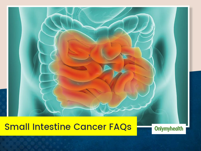 Small Intestine Cancer Know Cause Symptoms And Treatment Of This ‘slow Killer Onlymyhealth