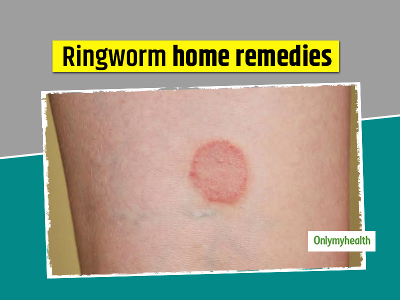Here Are 10 Home Remedies And Tips To Prevent Ringworm Here Are 10