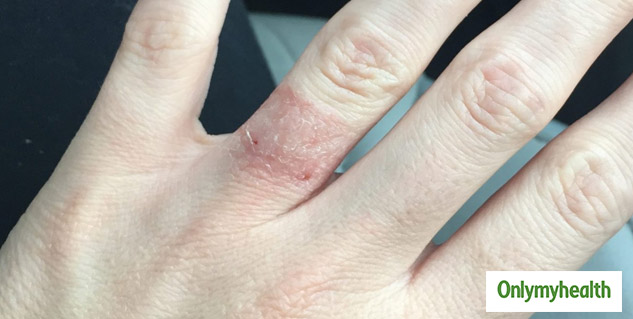 skin allergy from metal