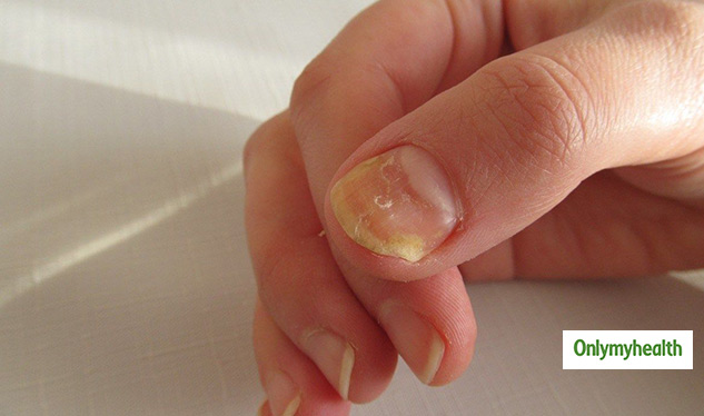 nails fungal infection