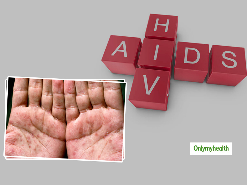 Are Rashes And Skin Conditions Associated With HIV/AIDS? Explains Dermatologist